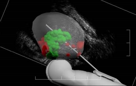 Как делается биопсия предстательной железы фото